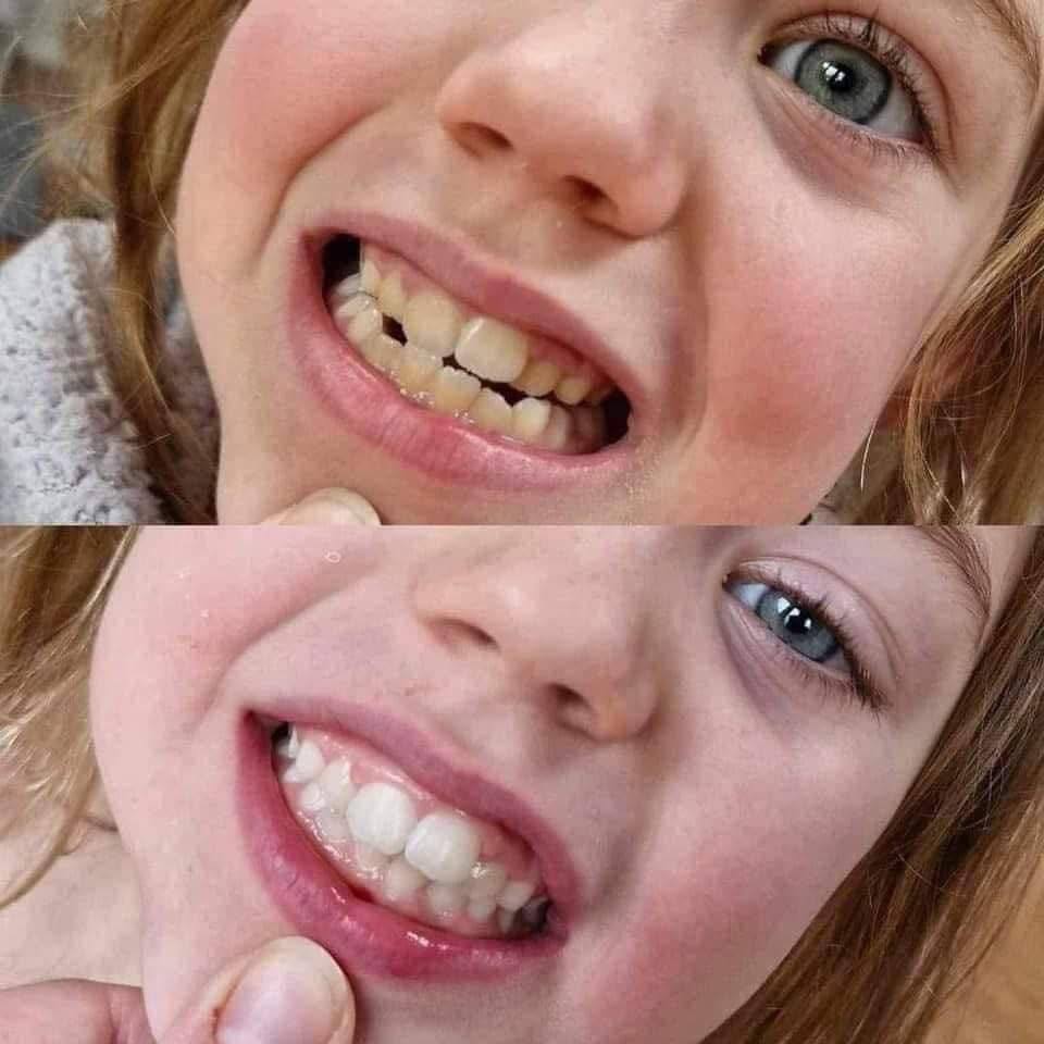 Whitening Toothpaste